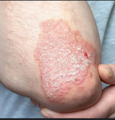 Psoriasis Treatment